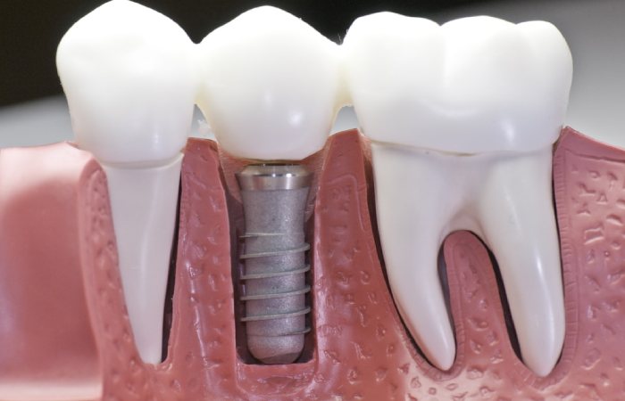 Dental Implants