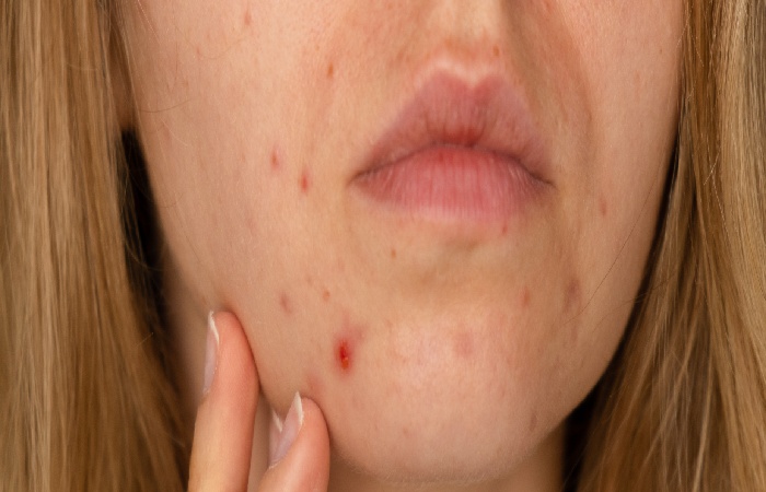 The Formation Of Acne Scars