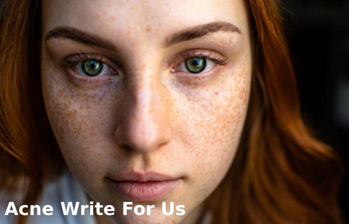 Acne Write For Us