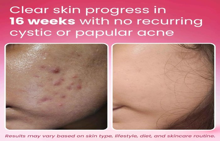 dermatouch face wash results before after