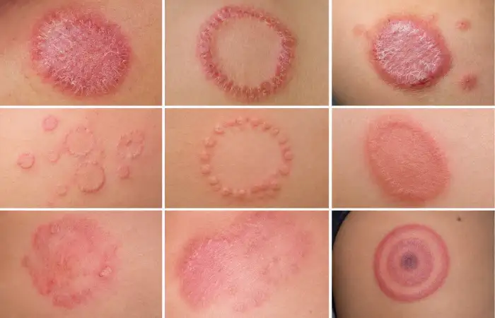 Rashes that look like ringworm but aren’t