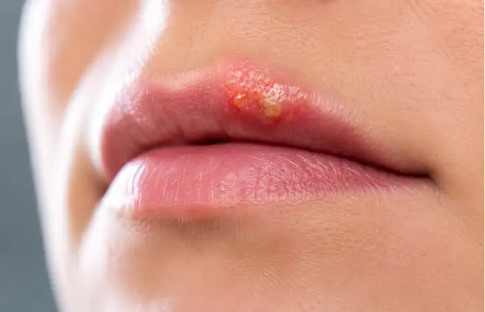 what Is a cold sore_