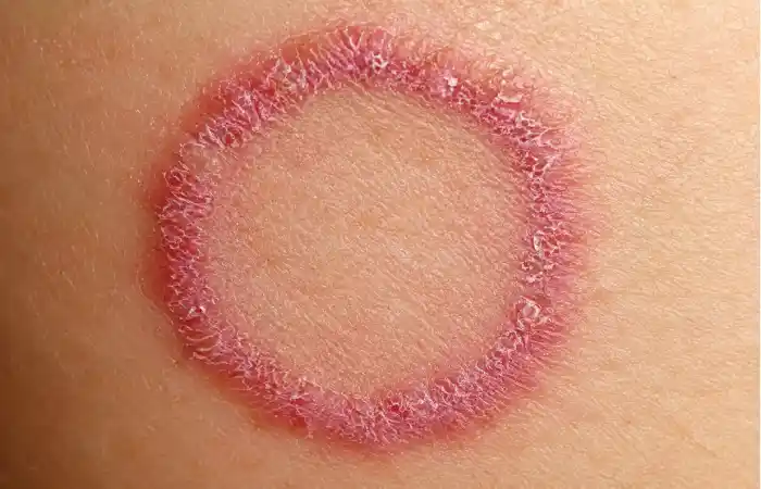 what does ringworm usually look like_